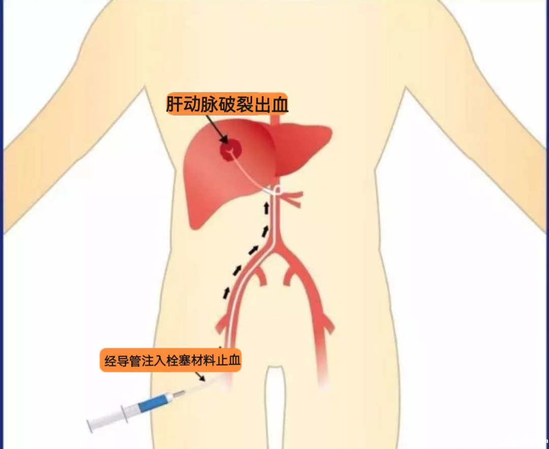 生死时速：raybet在线官网紧急救治92岁患者急性肝动脉破裂出血