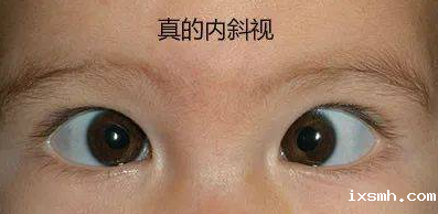 孩子歪头看？斗鸡眼？教您一个自测小妙招，准确分辨真假斜视