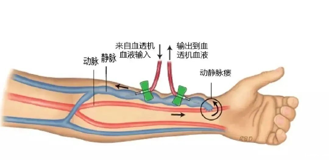 打通“生命线”，守护透析安全