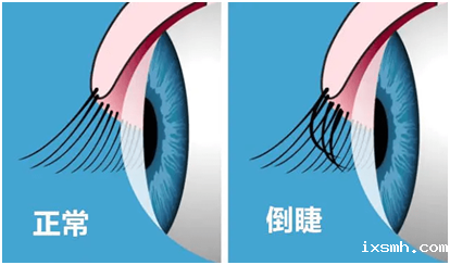 孩子频繁眨眼睛，可能是“睑内翻”“倒睫”在作祟！
