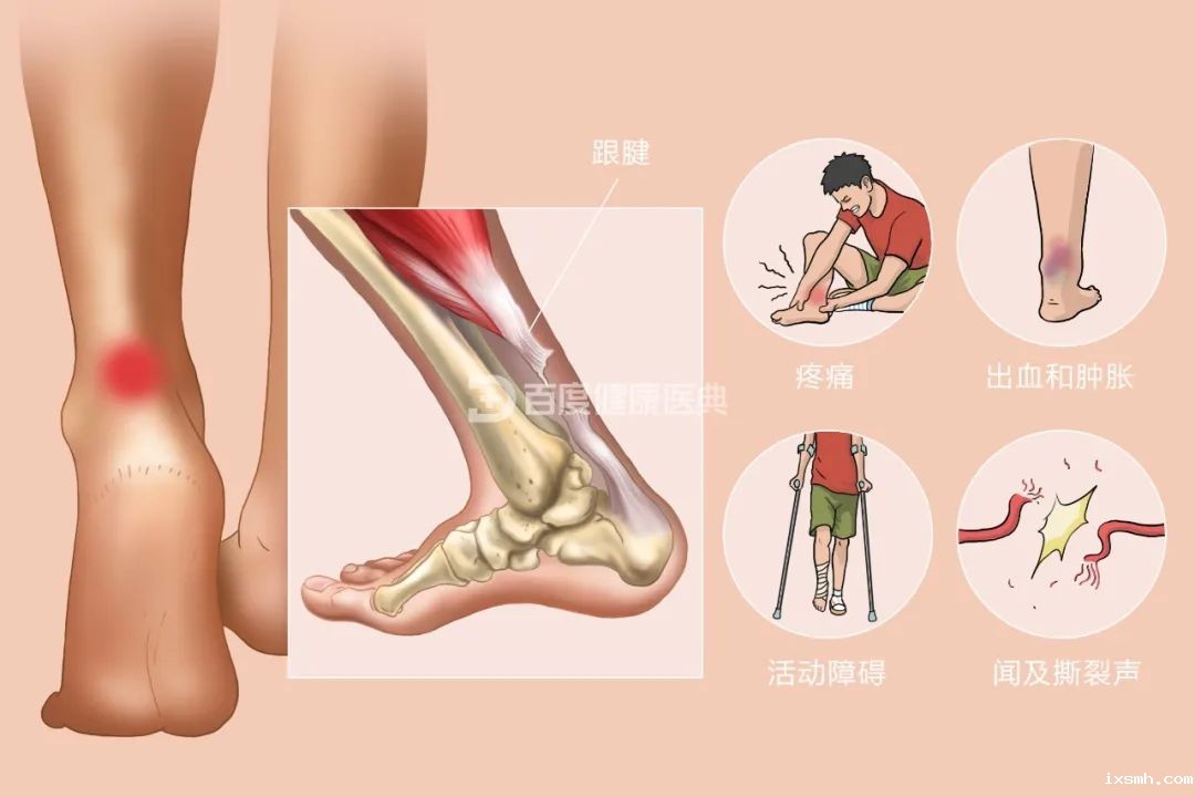 打篮球正嗨时，“啪”的一声！跟腱断了......