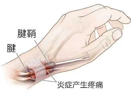 腱鞘炎：小炎症，大困扰？看这里，轻松破解！