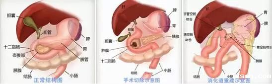 7个小时，5个小孔，3个厘米——raybet在线官网普外三科征服腹腔镜手术的“珠穆朗玛峰”