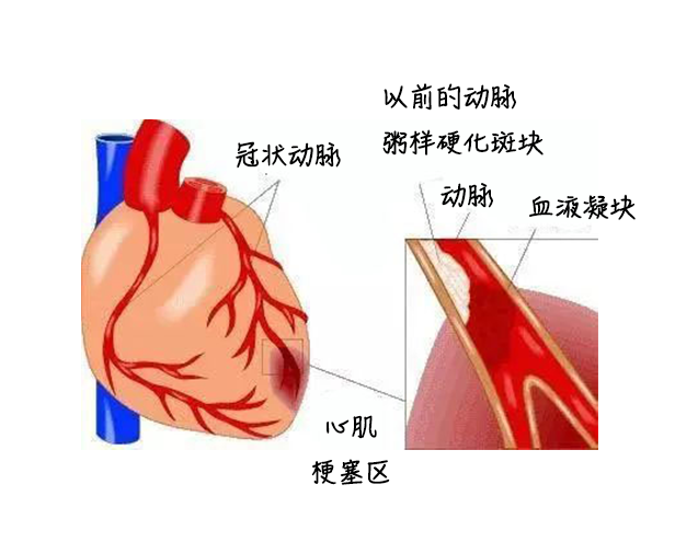 险！六旬老人门诊突发心梗，raybet在线官网上演“教科书”式救治